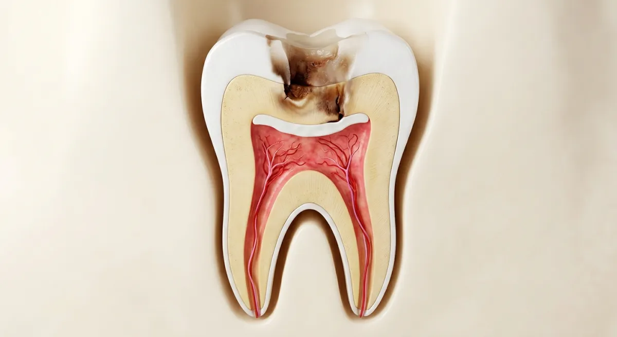 پوشش مستقیم/غیرمستقیم پالپ (پالپ کپینگ) — Direct / Indirect Pulp Capping